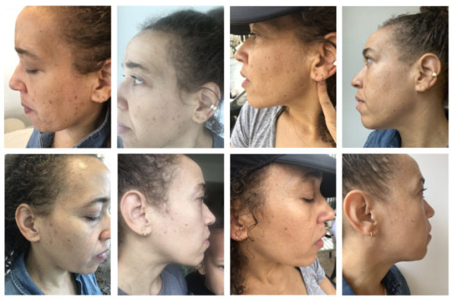 Microneedling: Before And After